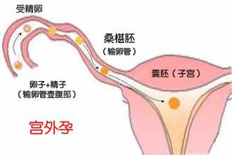借卵做试管自怀能排除遗传缺陷吗？