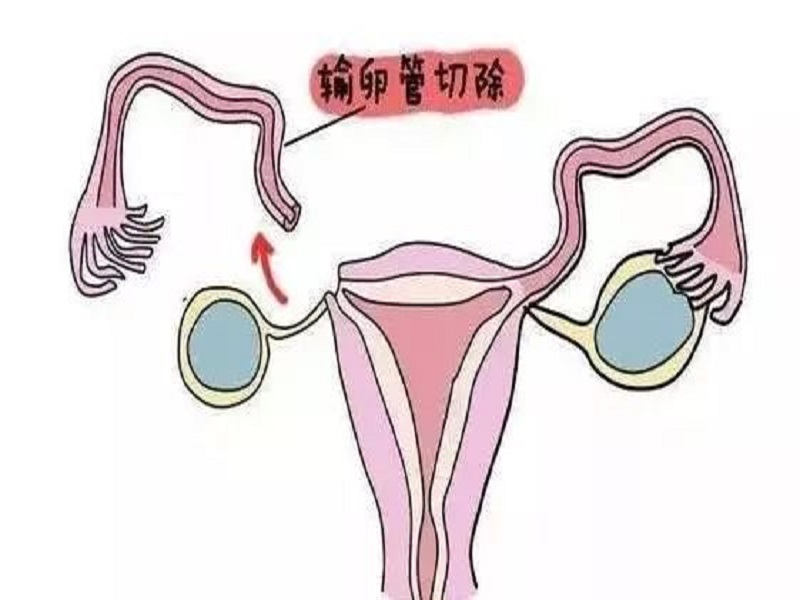 没有输卵管做借卵试管会宫外孕吗