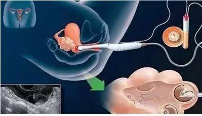 北京市西囡做试管的费用_如何预防多囊卵巢复发